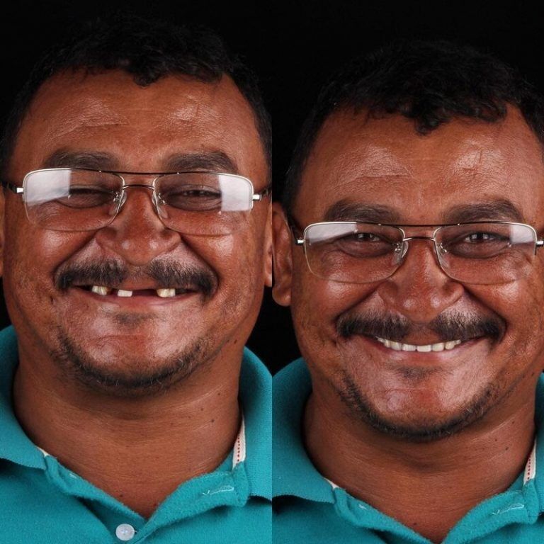 Зъболекарят показа как се променя усмивката на човек, който най-накрая е излекувал болни зъби 9