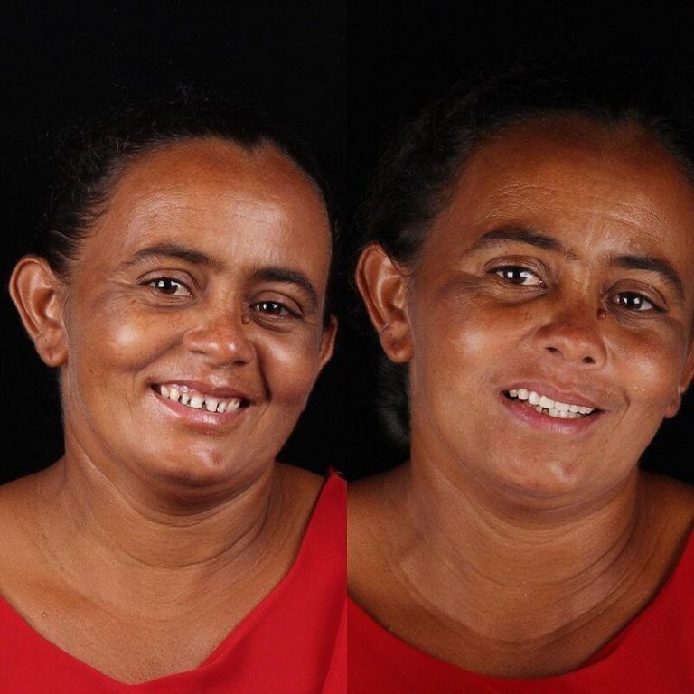 Зъболекарят показа как се променя усмивката на човек, който най-накрая е излекувал болни зъби 2