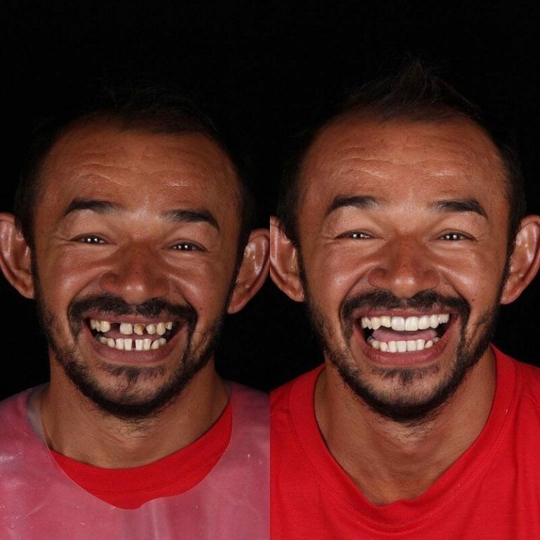 Зъболекарят показа как се променя усмивката на човек, който най-накрая е излекувал болни зъби 3