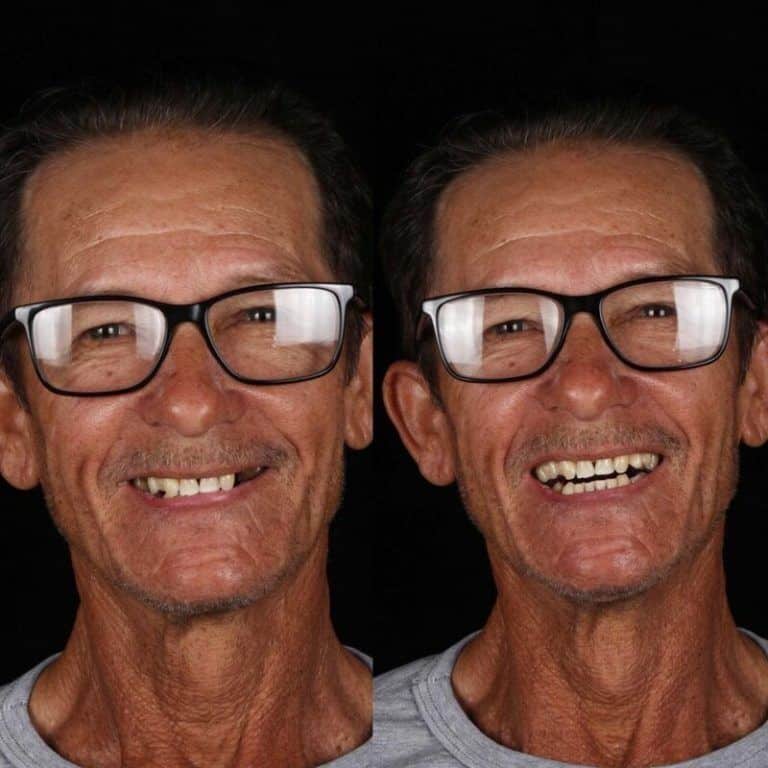 Зъболекарят показа как се променя усмивката на човек, който най-накрая е излекувал болни зъби 8