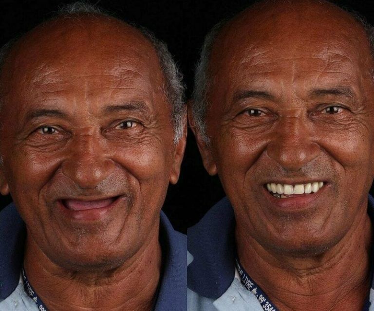 Зъболекарят показа как се променя усмивката на човек, който най-накрая е излекувал болни зъби 4