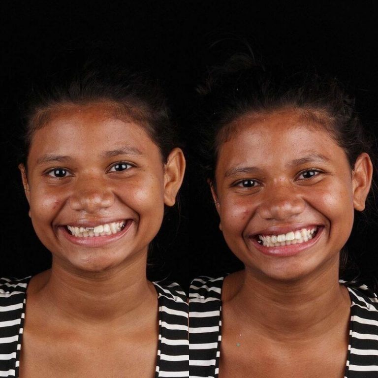 Зъболекарят показа как се променя усмивката на човек, който най-накрая е излекувал болни зъби 11