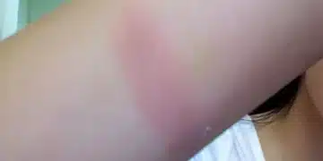 Ето какво трябва да направите при изгаряне, за да си помогнете, а не да си вредите с мас! 11