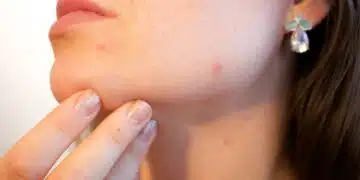 акне