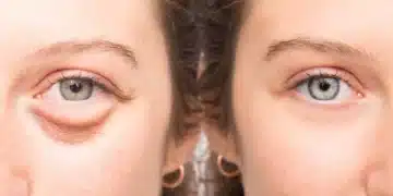 подути очи