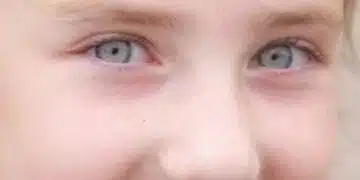 Как да се отървете от луничките по лицето си: домашни средства 2