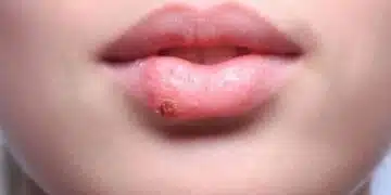 Когато се появява върху устните е изключително неприятно, много боли и не се лекува никак лесно – какво трябва да знаем 1