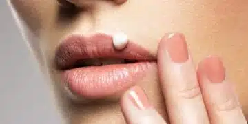 Херпесът често ли се връща? 6 причини, поради които това се превръща в постоянен проблем 1