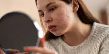 Имате ли пъпки по лицето? Ето как бързо да откриете причината и да се отървете от тях 1